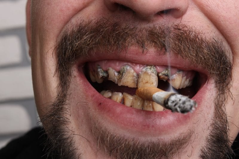 Cigarette Smoking On Oral Health